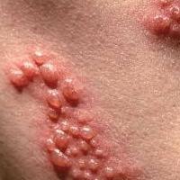 Bir çocukta herpes: Halk ilaçlarıyla tedavi sadece