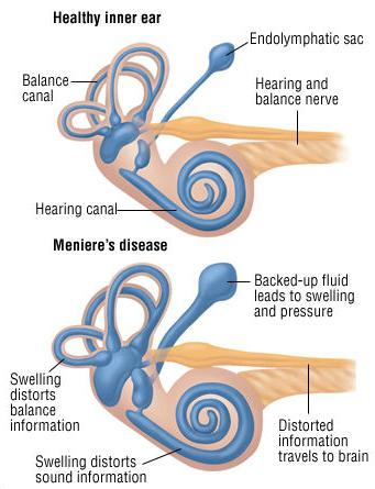 Meniere hastalığı nedir?