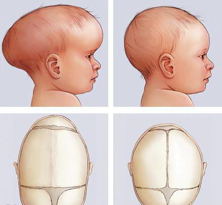 fetüste başın dolikosefalik şekli