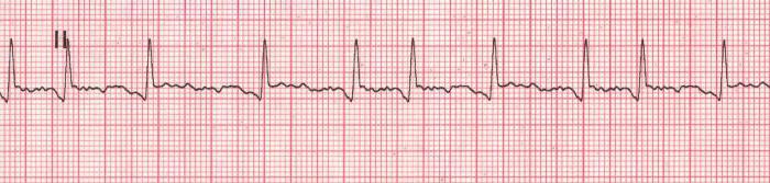 EKG'de atriyal fibrilasyon. Atriyal flutter