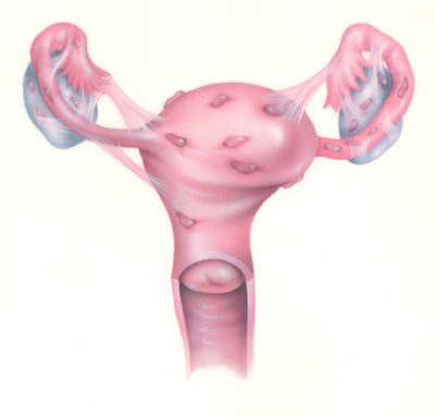 rahim endometriozis ki 