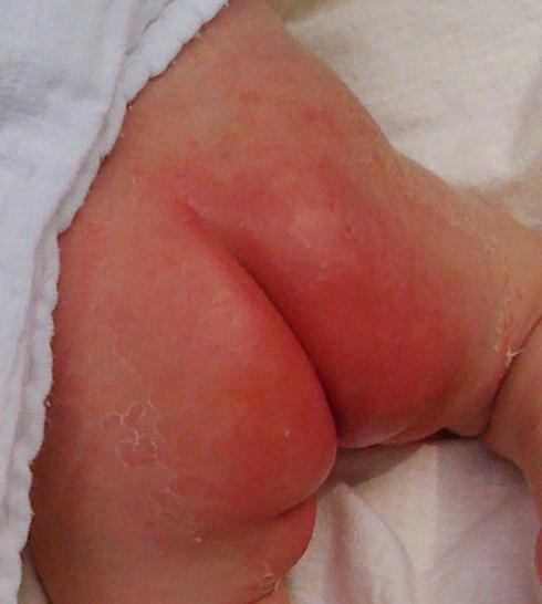 bebek bezi dermatit tedavisi