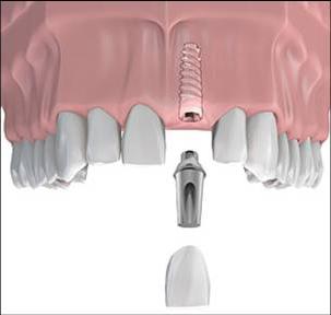 Bir diş implantının modern kliniklerinde maliyeti nedir?