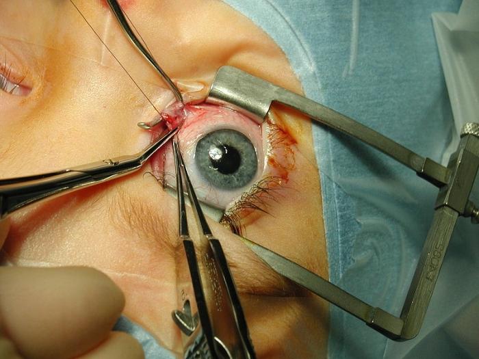 Bir göz ameliyatının maliyeti hakkında öğrendikten sonra, hoş bir sürpriz olacaksın